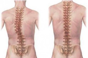 Kuyruk Sokumu Tümörü Belirtileri ve Tedavisi