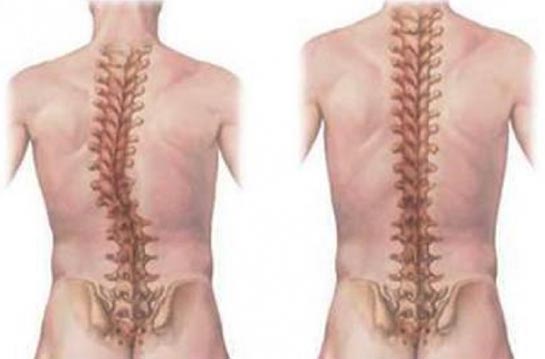 Kuyruk Sokumu Tümörü Belirtileri ve Tedavisi